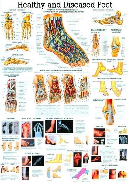 Anatomie Poster gezonde en zieke Voet 70 x 100cm. | GELAMINEERD